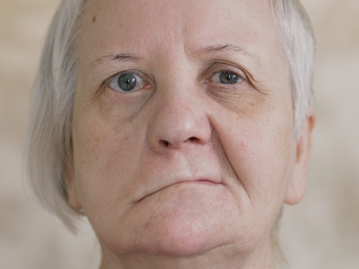 Facialislähmung
