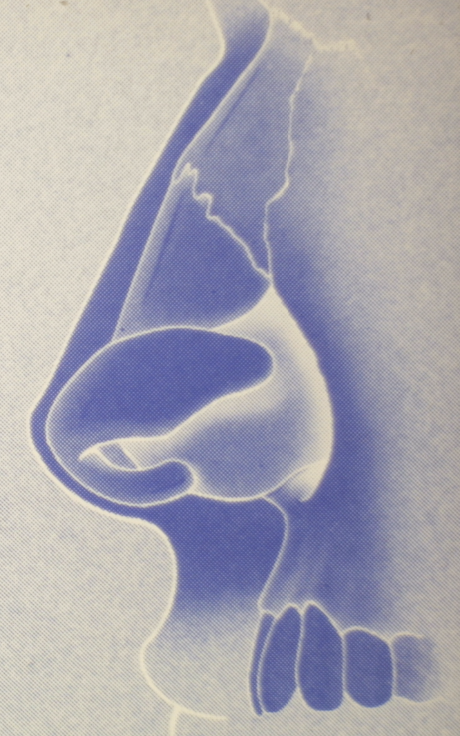 Nasenchirurgie
