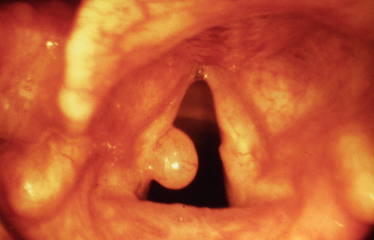 Phonochirurgie