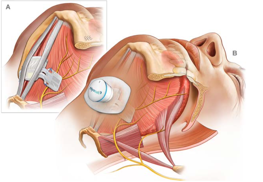 Implantation Zungengrundschrittmacher